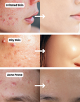 Acne Control Bundle
