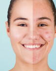Acne Control Cream