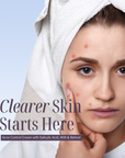 Acne Control Cream