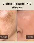 Whitening Melasma Combo