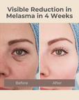 Melasma Rejuvenating Night Cream