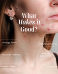 Acne Control Cream