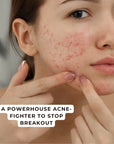 Acne Control Cream