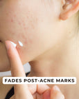 Acne Control Cream