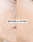 Acne Control Cream