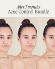 Acne Control Bundle