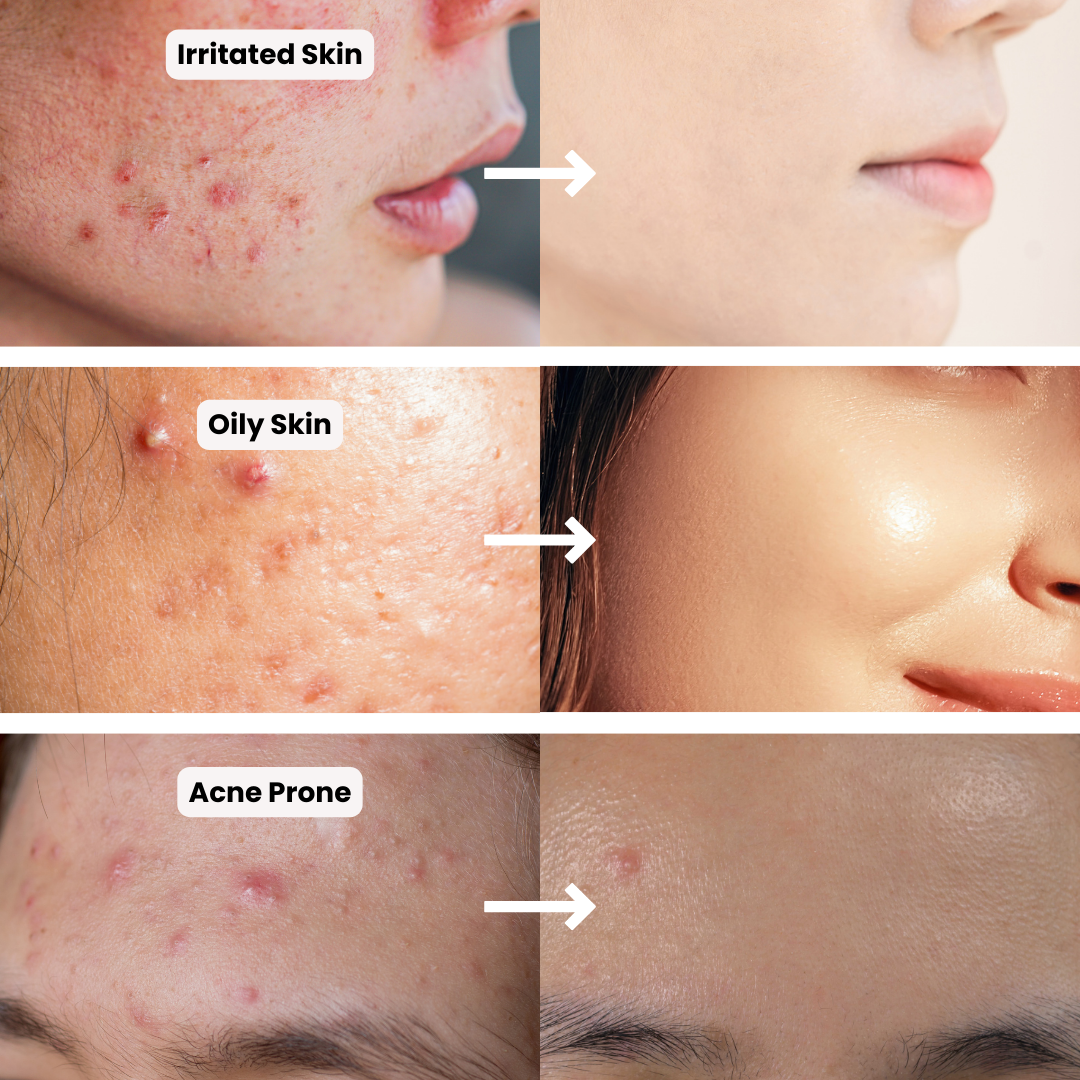 Acne Control Bundle