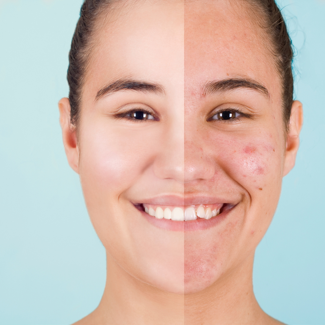 Acne Control Cream