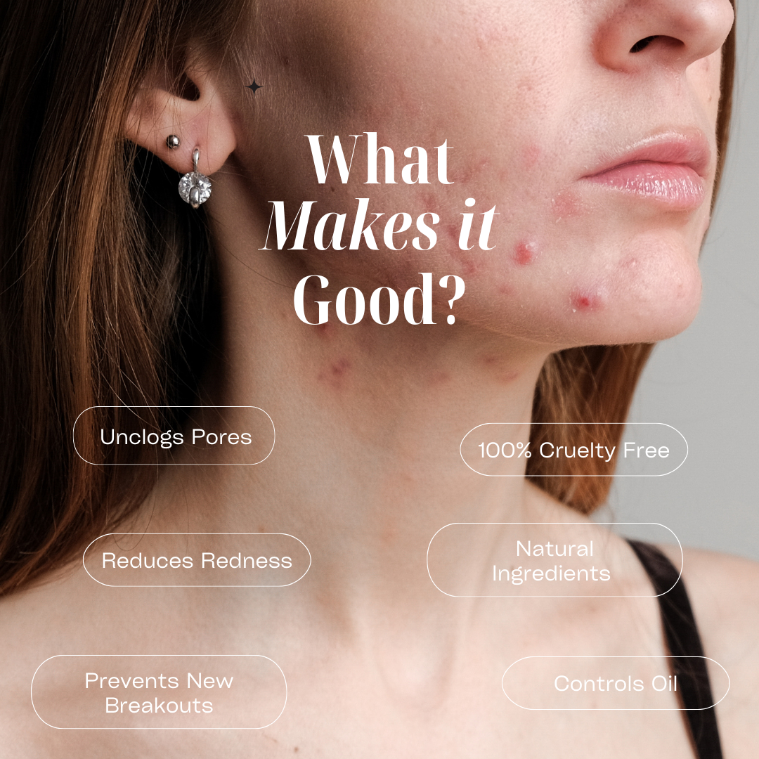 Acne Control Cream