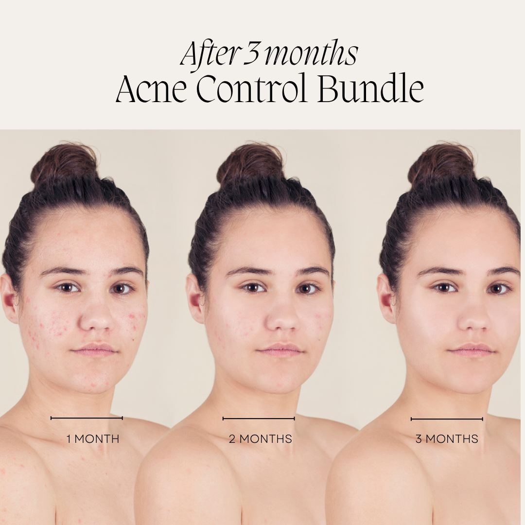 Acne Control Bundle