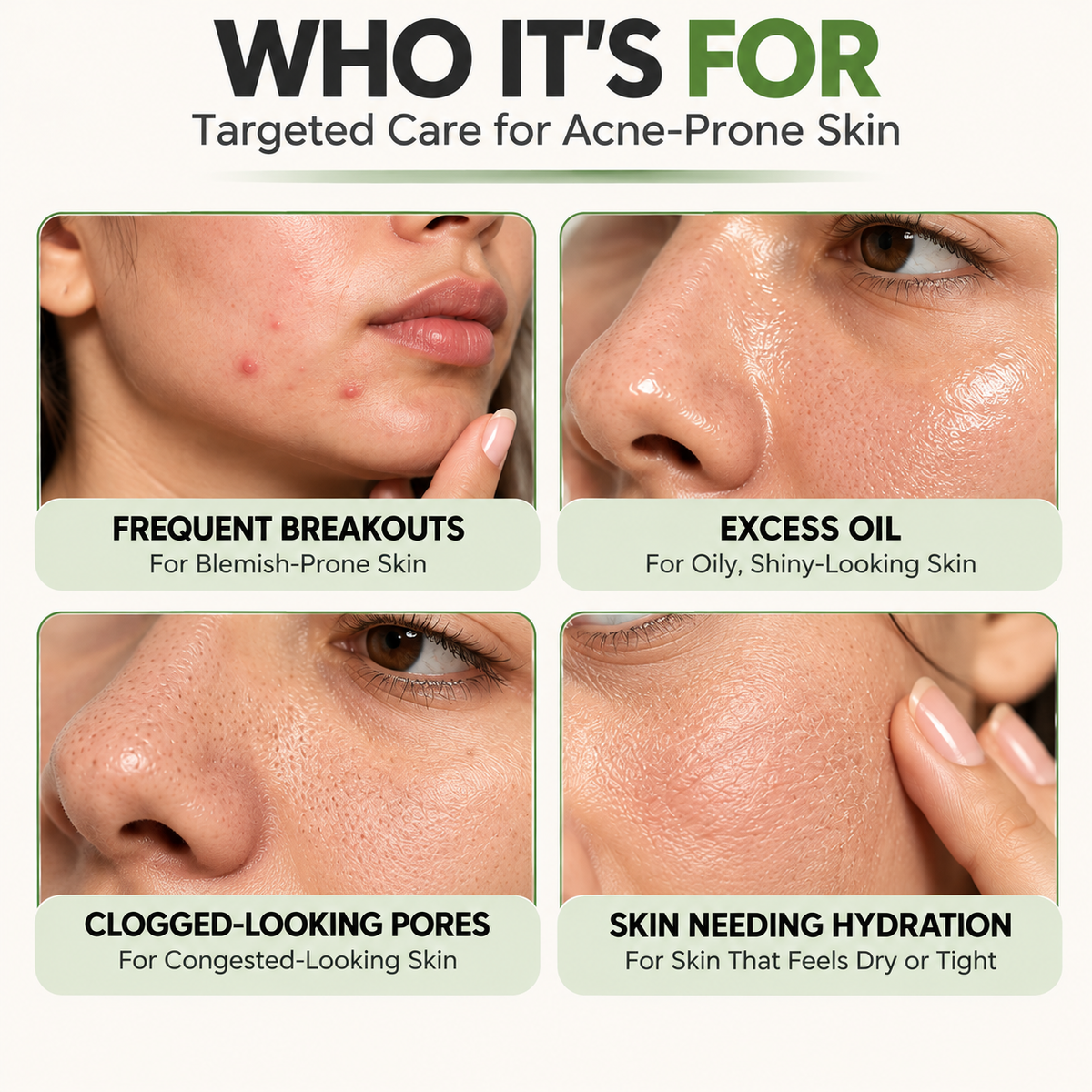 Acne Control Cream