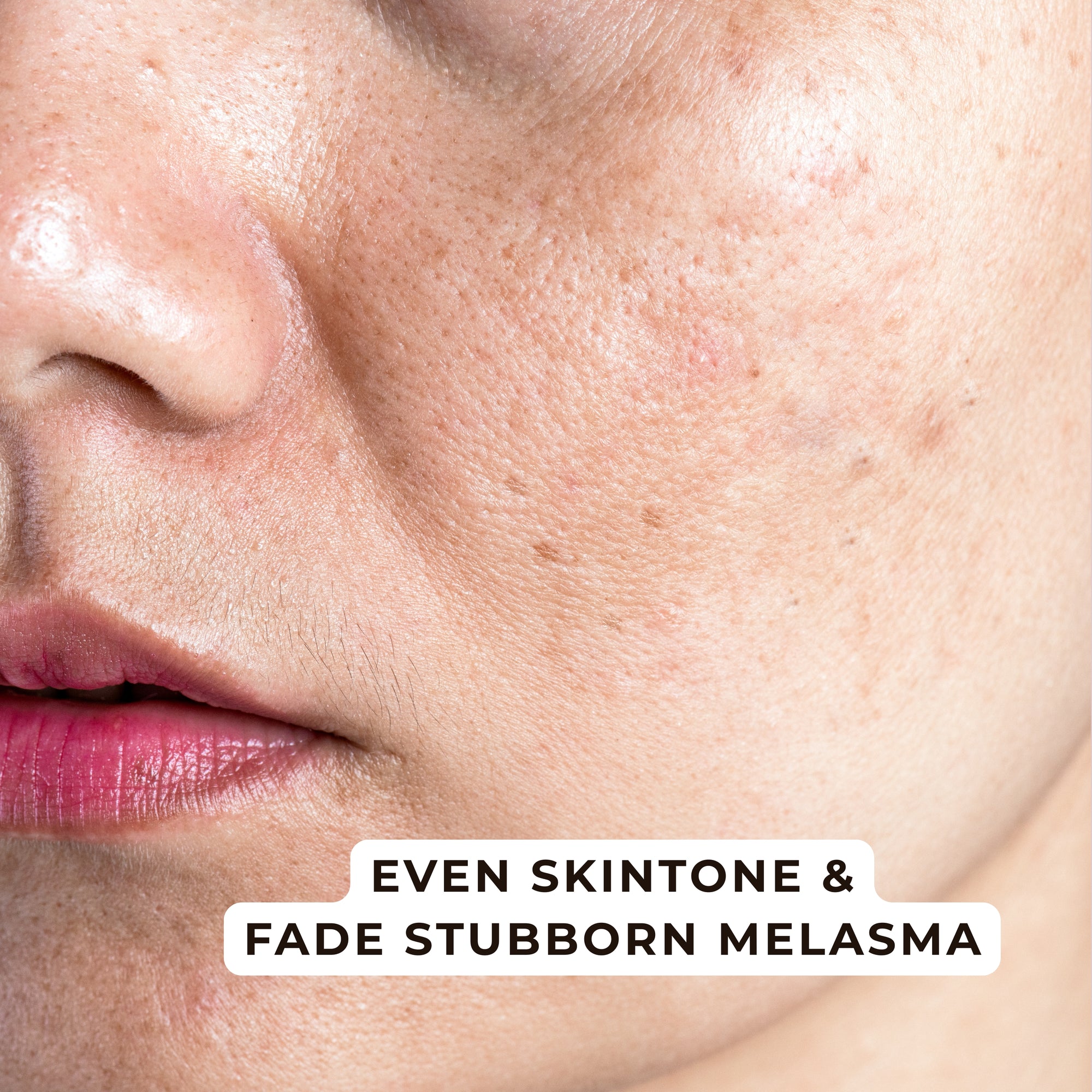 Whitening Melasma Duo