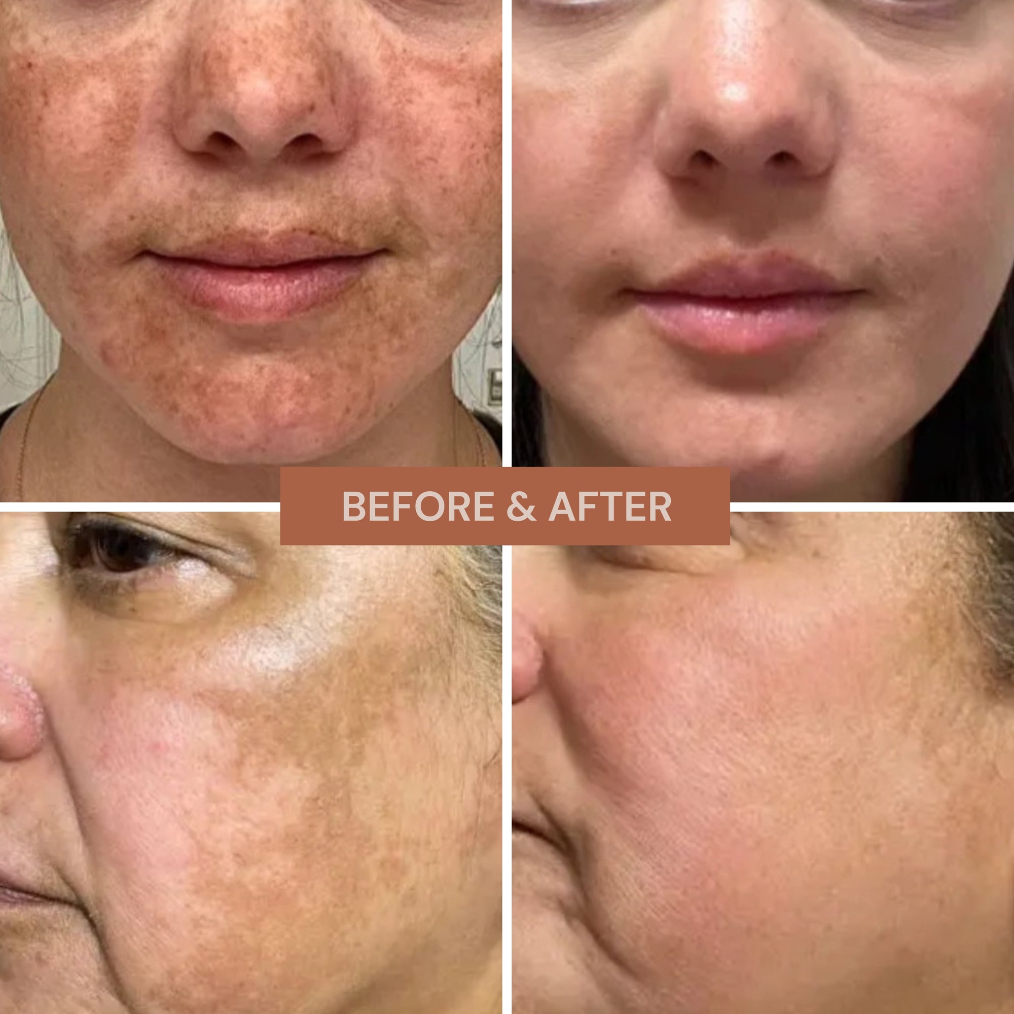 Whitening Melasma Duo